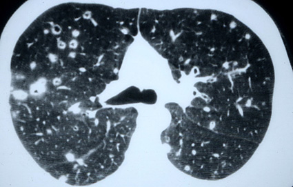 L'atteinte pulmonaire de l'adulte - histiocytose.org