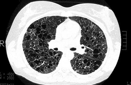 L'atteinte pulmonaire de l'adulte - histiocytose.org