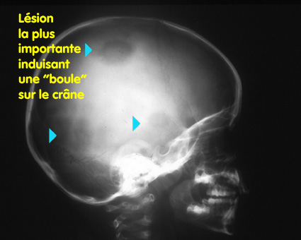 Les localisations - histiocytose.org