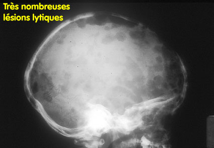 Très nombreuses lésions lytiques