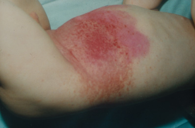 Lesion de la peau