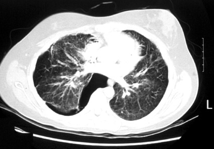 Pneumothorax, photo 1