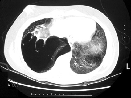 Pneumothorax, photo 2