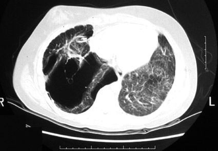 Pneumothorax, photo 3